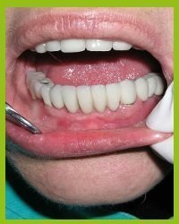 implantologia dentale milano